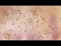 SQUEEZE BLACKHEADS and PIMPLES...