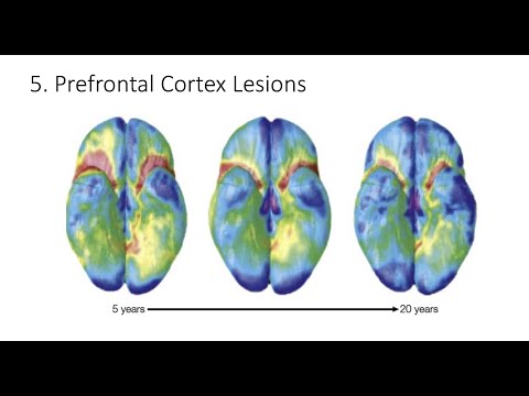 9.5. Prefrontal Cortex Lesions, Fundamentals of Cognitive Neuroscience Course, Session 9, Part 5