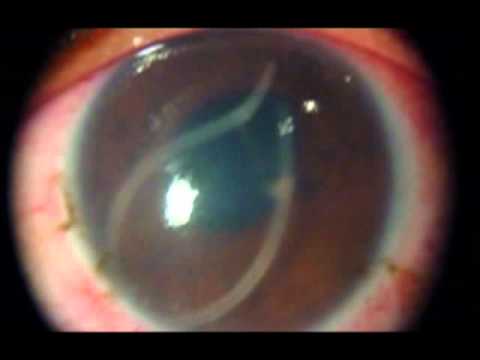 helmintus dirofilariasis