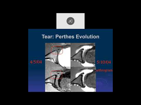 MRI of the Shoulder 2023 – Anterior Labral Tears, Part 2