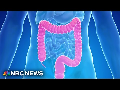 New blood test is added an an option for colorectal cancer screenings