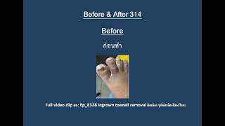 BA_314 Before and After 👣 มาดูแผลเล็บขบหลังจากน้องมาทำกับพี่เอื้อม 😷 (Ep_8328)