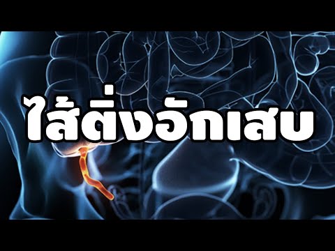 เรื่องเล่า ผ่าตัดไส้ติ่งอักเสบ