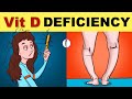 Vitamin D Deficiency | Vitamin D Deficiency Symptoms | Vitamin D Deficiency Rickets | Osteomalacia