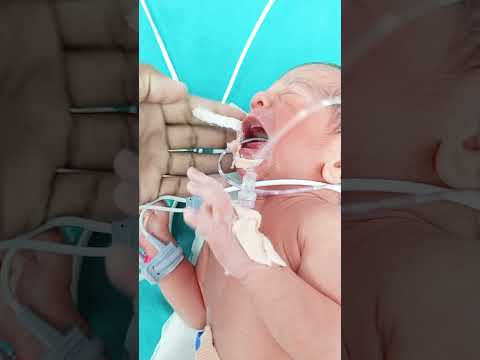 NICU Protocol: Handling Preterm Babies 👶🩺