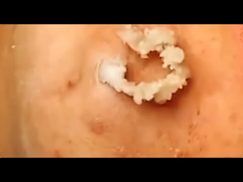 Popping a CYST filled with pus.