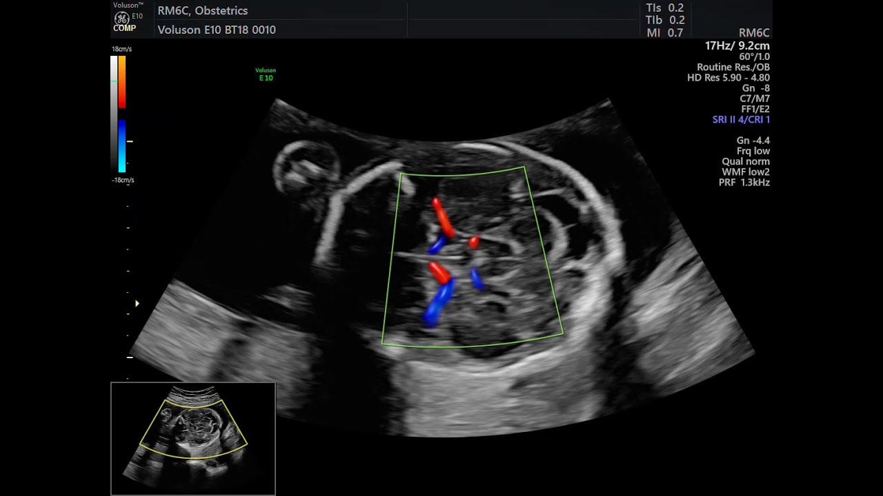 CIRCULAÇÃO POLÍGONO WILLIS  CEREBRO FETAL