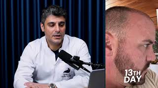 Dr. Gökay Bilgin’s 4400-Graft Hair Restoration | Smile Hair Clinic