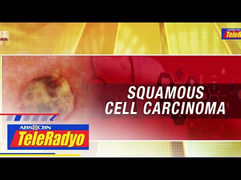 Alamin ang mga sanhi at kung paano maiiwasan ang squamous cell carcinoma Lingkod Kapamilya