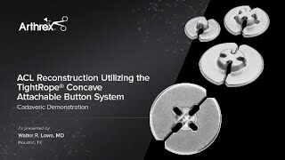 ACL Reconstruction Utilizing the TightRope® Concave Attachable Button System