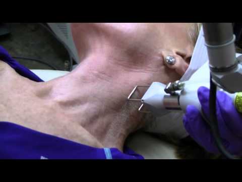 DEKA DOT Laser Skin Resurfacing | Moradi MD