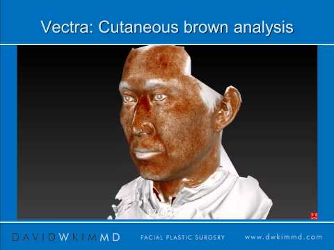 IPL - Intense Pulse Light