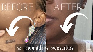 HOW MY DERMATOLOGIST GOT RID OF MY KELIOD SCAR | MY KELIOD TREATMENT