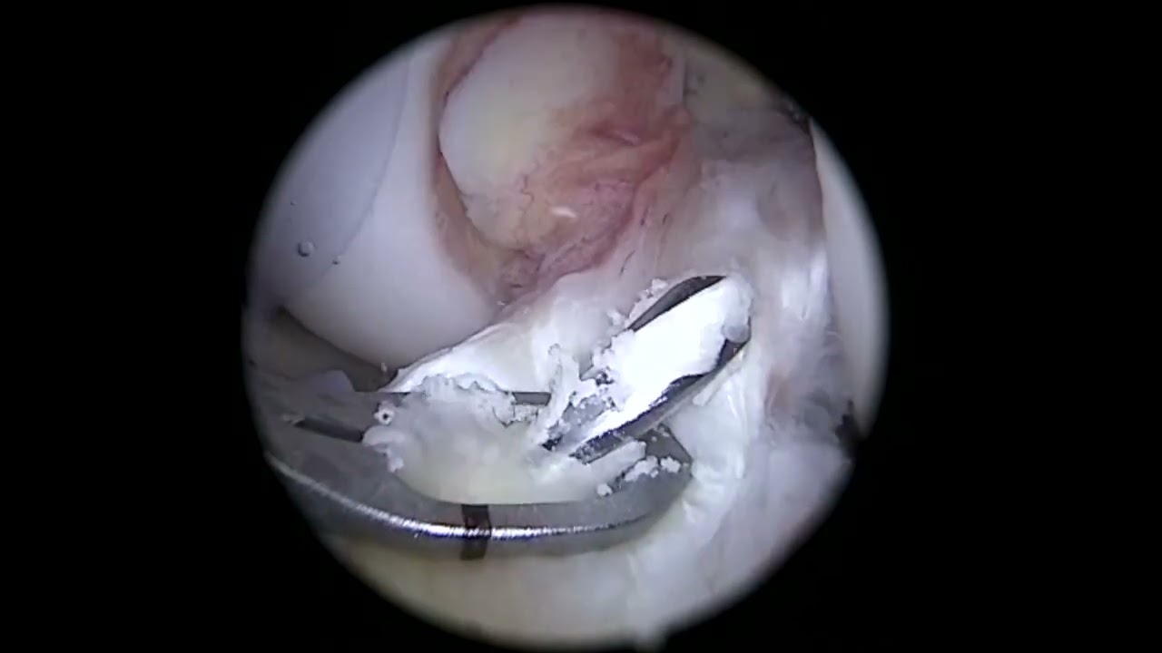 ACL repair, MCL repair, Lateral meniscal root repair