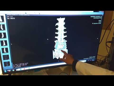 Testimonio de extranjera en Clínica de Columna Vertebral 3/5