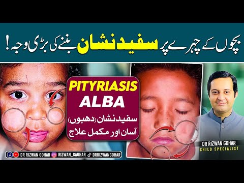 Get Rid of White Spots on Face Forever  | ! #whitespots #skin #pityriasisalba