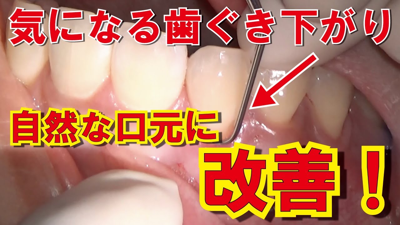 根面被覆で歯ぐき下がりを改善し自然な口元に!! Improves Gingival Retraction With Root Coverage !!