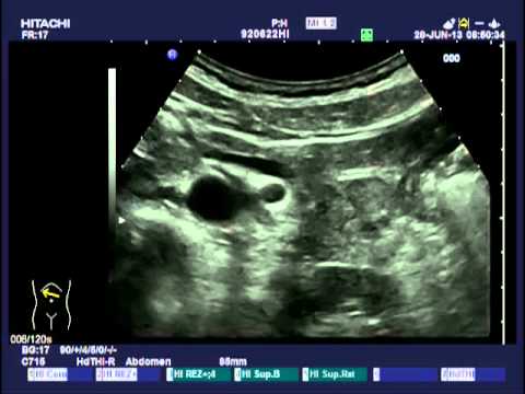 Prostatahyperplasie Symptome und Behandlung Behandlung von Prostatitis bei Neumyvakin