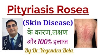 Pityriasis Rosea (Skin Disease) का CompleteTreatment in Hindi || By Dr Yogendra Bola