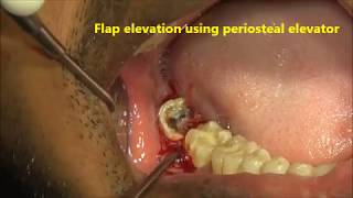 Extraction of grossly decayed tooth using spade elevator