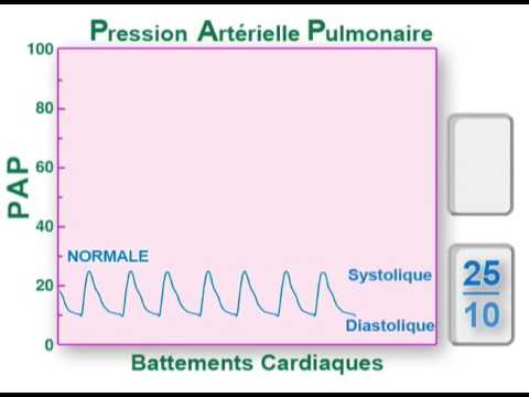 Signes dhypertension insuffisance rénale гипÐμÑ € Ñ, Ð¾Ð½Ð¸Ñ ‡ ÐμÑ ÐºÐ ° Ñ Ð ± оР»ÐμÐ · нь Ñ Ñ € 3N, ÐμпÐμнь DN к 4