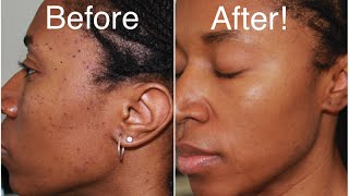 How To Get Rid of Moles and Dark Spots Fast (DPNS)
