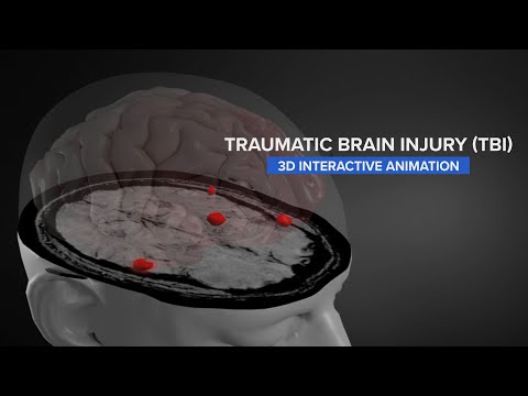 3D Interactive Animation Reveals Hemorrhaging Found In MRI Scans of Brain