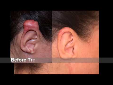 Best "#Keloid Treatment" for most difficult ear keloid