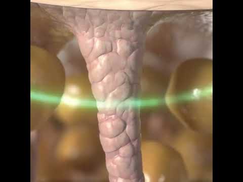 Onda body contouring device, Al Mahmoud medical center, Dubai, UAE