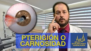 PTERIGIÓN O CARNOSIDAD EN LOS OJOS