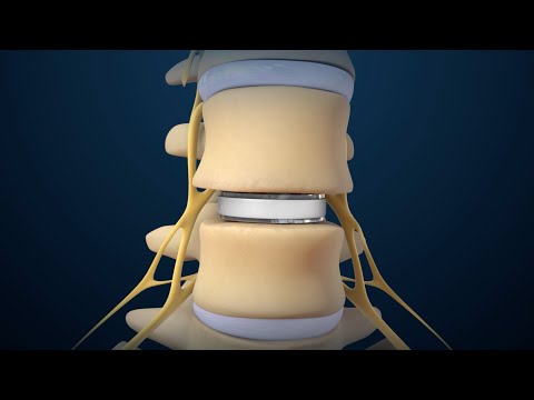 Back Surgery: Lumbar Disc Replacement