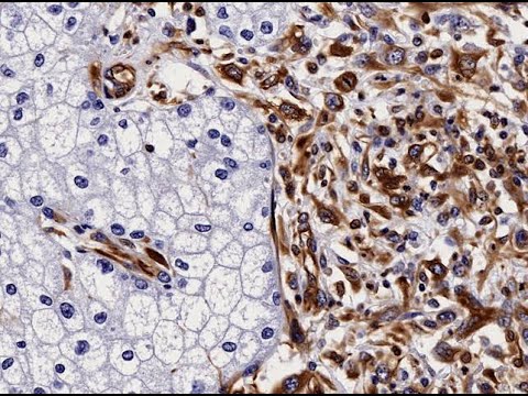 Vimentin stain (an immunohistochemical technique used to detect vimentin) ; Purpose, Application