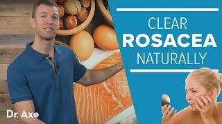 Rosacea Treatment: Help Clear Redness Naturally in 7 Steps