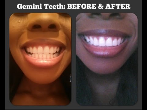 How to Get Super White Teeth Pt. 3 | Gemini HOME Edition LIVE DEMO and Review