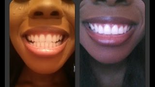 How to Get Super White Teeth Pt. 3 | Gemini HOME Edition LIVE DEMO and Review