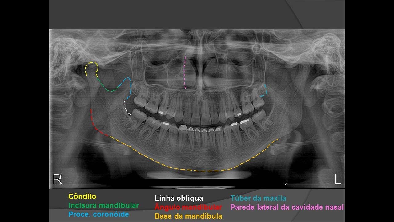 Anatomia em radiografia panorâmica