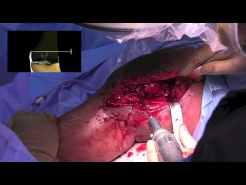Distal Femoral Osteotomy (DFO) and Subchondroplasty