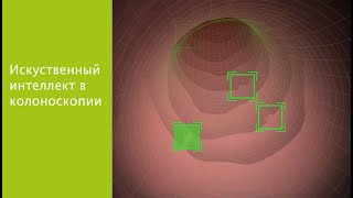 Искусственный интеллект в колоноскопии в частной клинике Конфратернитет, Вена, Австрия