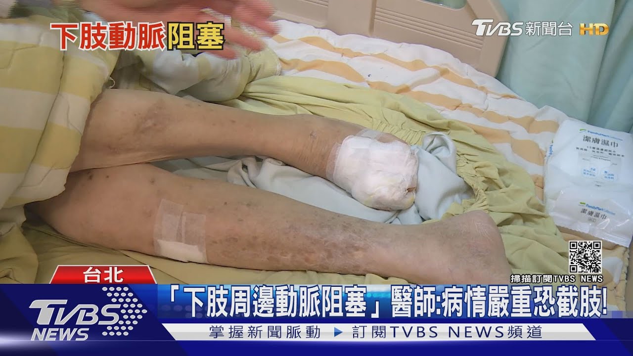 不理會！這六個危險因子　引起「下肢周邊動脈阻塞」醫：恐截肢