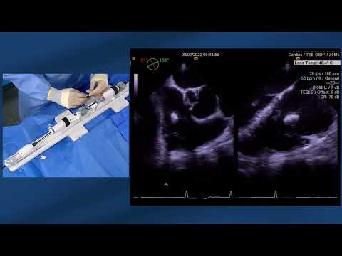 Tricuspid edge-to-edge repair with the Pascal device