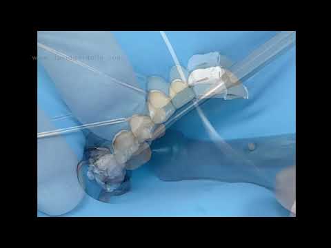 David Gerdolle -  Onlays/Veneers Adhesive Cementation with Warmed Composite   #addent
