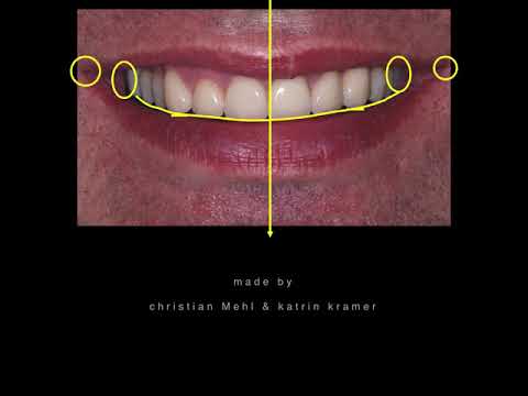 The Golden Rules of Aesthetic Smile & What Factors Affect Them?