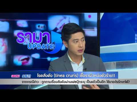 ครีมกลากที่ชื่อมือ น้ำมันยี่หร่าสีดำสำหรับโรคสะเก็ดเงิน