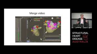 Where are we at with 3D Mapping: Electroanatomic Mapping – A/Prof Stuart Thomas