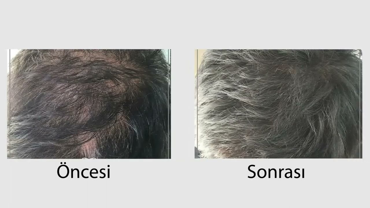 Saç Simülasyonu Öncesi Sonrası