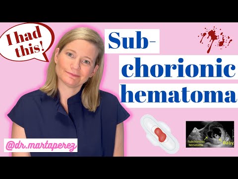OBGYN Explains Subchorionic Hematoma | My Story First Trimester Bleeding