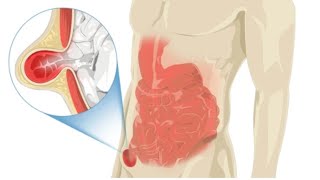 Unbelievable Inguinal Hernia Surgery Footage!