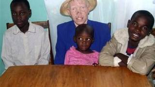 Witch Doctors Killing Albinos To Sell Body Parts