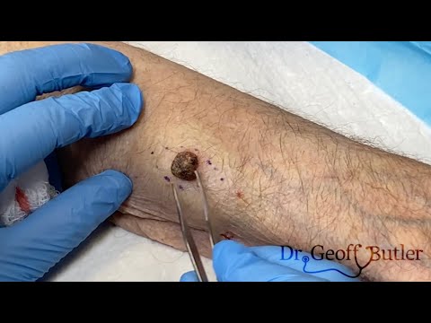 Removal of a Squamous Cell Cancer on the Forearm.