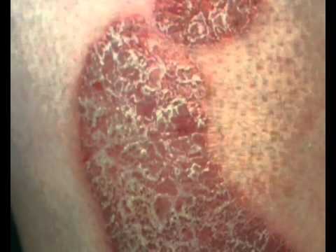psorijaza hipertenzija koji stupanj hipertenzije je najviša